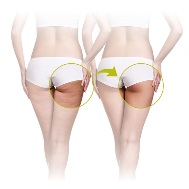 Hierontalaite selluliittia varten Lanaform Skin Mass 2