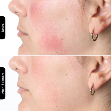 Facial rejuvenating LED mask Silk'n Face Mask 100 11